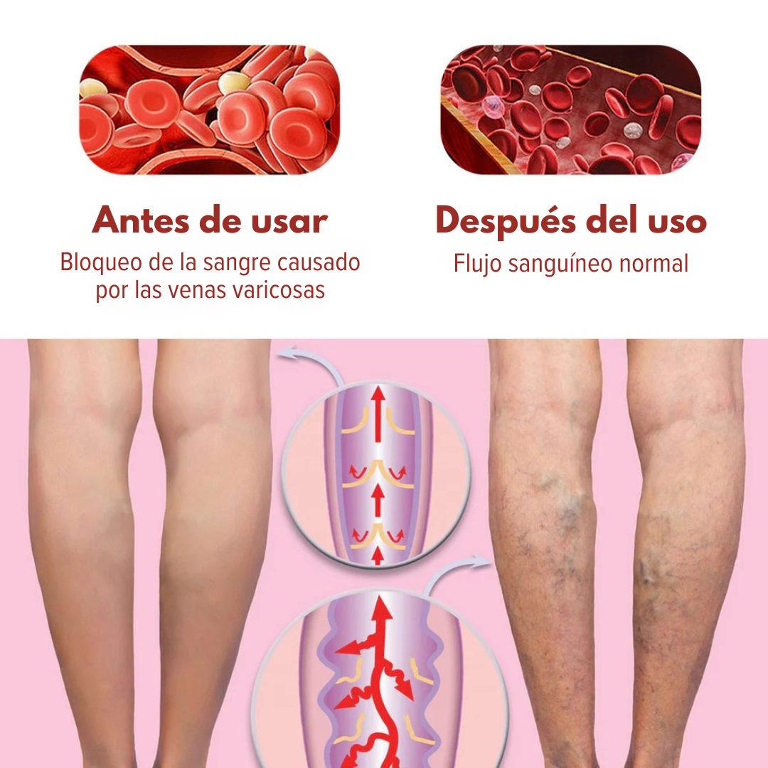 Varicose Veins™ Crema| El secreto para unas piernas radiantes.